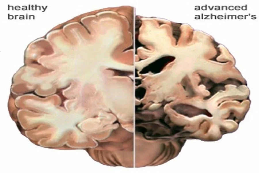Healthy brain and advanced Alzheimer’s brain